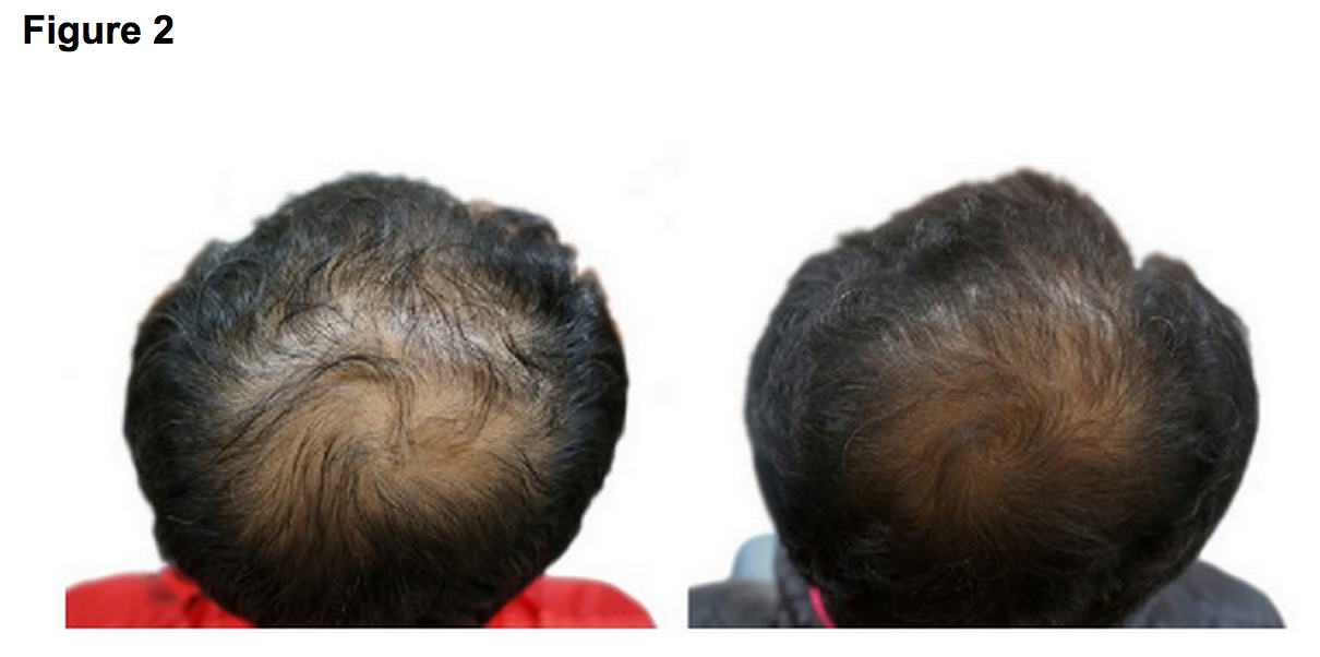 Hair regrowth images
